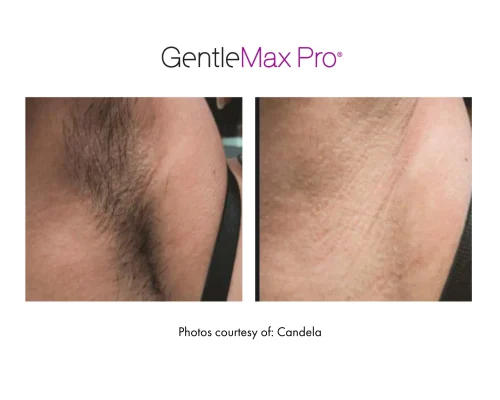 laser_hair_removal_10