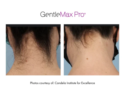 laser_hair_removal_11