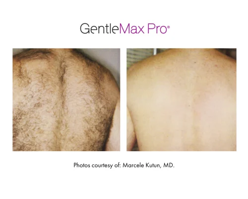 laser_hair_removal_5