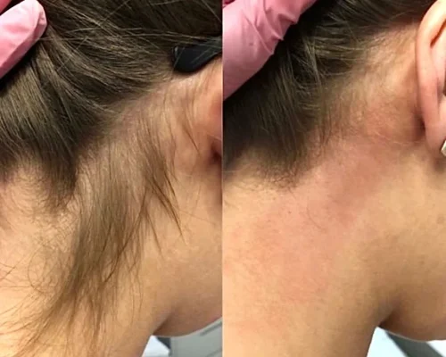 laser_hair_removal_6