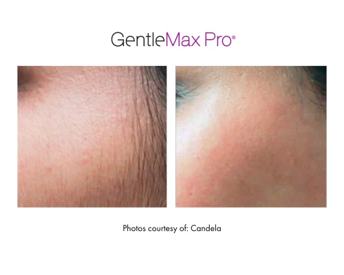 laser_hair_removal_7