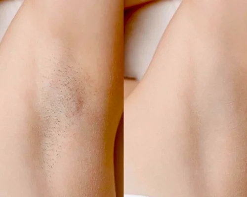 laser_hair_removal_8