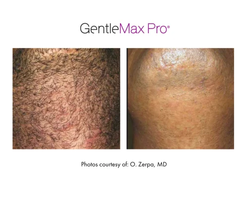 laser_hair_removal_9